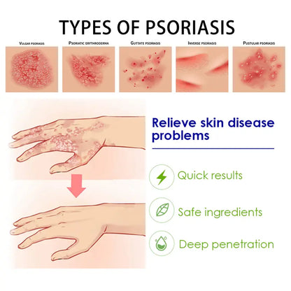 ✨ Advanced Psoriasis & Sensitive Skin Relief Cream – Calm, Hydrate & Restore Comfort