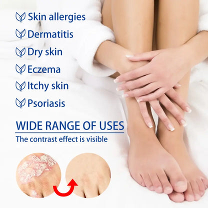 ✨ Advanced Psoriasis & Sensitive Skin Relief Cream – Calm, Hydrate & Restore Comfort